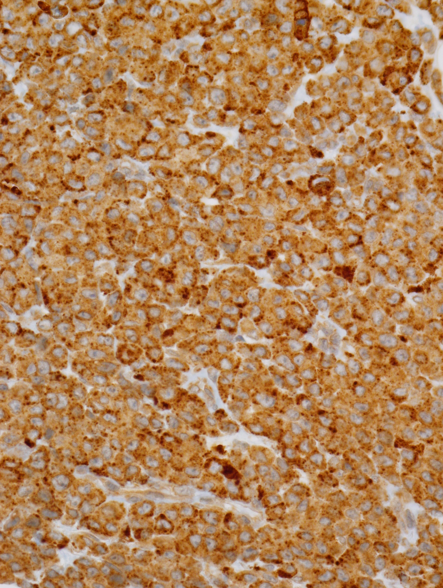 Fig. 3 Left buttock lesion. Immunohistochemistry for CD45, CD33 (Fig. 3a), lysozyme (Fig. 3b), and CD68 (Fig. 3c) were diffusely and strongly positive. CD34 (Fig. 3d), CD117 (Fig. 3e), and myeloperoxidase (Fig. 3f) were not expressed. Additionally, CD56, cytokeratin AE1/AE3, cytokeratin 17, cytokeratin 20, Melan-A, PSA, S-100, CD1a, CD3, CD20, CD21, CD35, CD56, CD123, CD138, CD163, and PAX-5 were negative.